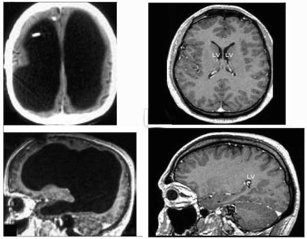 brain lo res