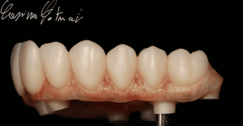 dentalimplant